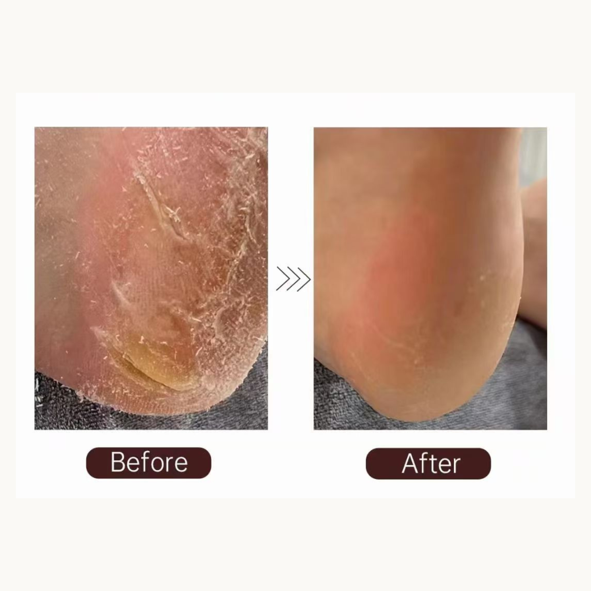 HIGHS Coffee Foot Callus Removal Spray – Fast Softening Foot Care ...
